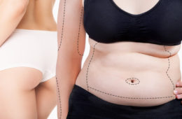 Pokud se rozhodujete, zda podstoupit liposukci, jistě vás zajímá, jak vybrat nejlepší zákrok. Máme pro vás srovnání jednotlivých metod liposukcí.