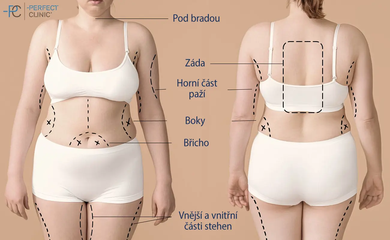 Podívejte se, které partie těla lze formovat liposukcí. 